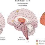 Estágios de Braak no Parkinson