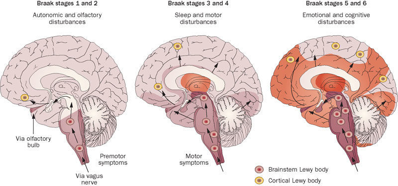 Estágios de Braak no Parkinson