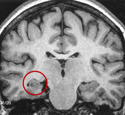 Atrofia de hipocampo é uma das causas da epilepsia.