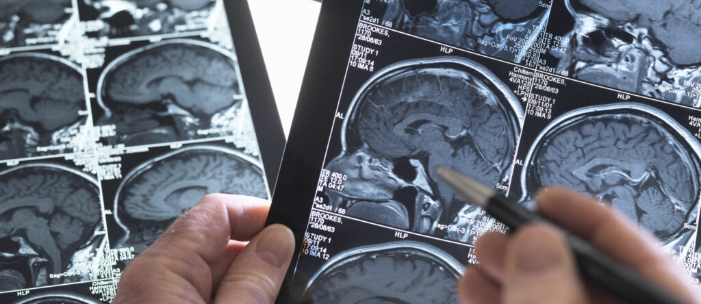 Imagem de uma ressonância magnética do cérebro sendo analisada pelo Dr. Roger Soares para o diagnóstico de Alzheimer.